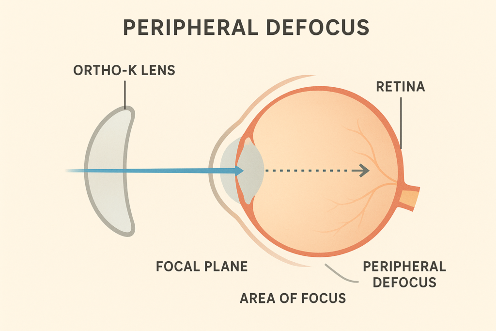 Diagram illustrating peripheral myopic defocus created by specialized contact lenses to modulate the Ocular Biomechanics of Myopia progression.