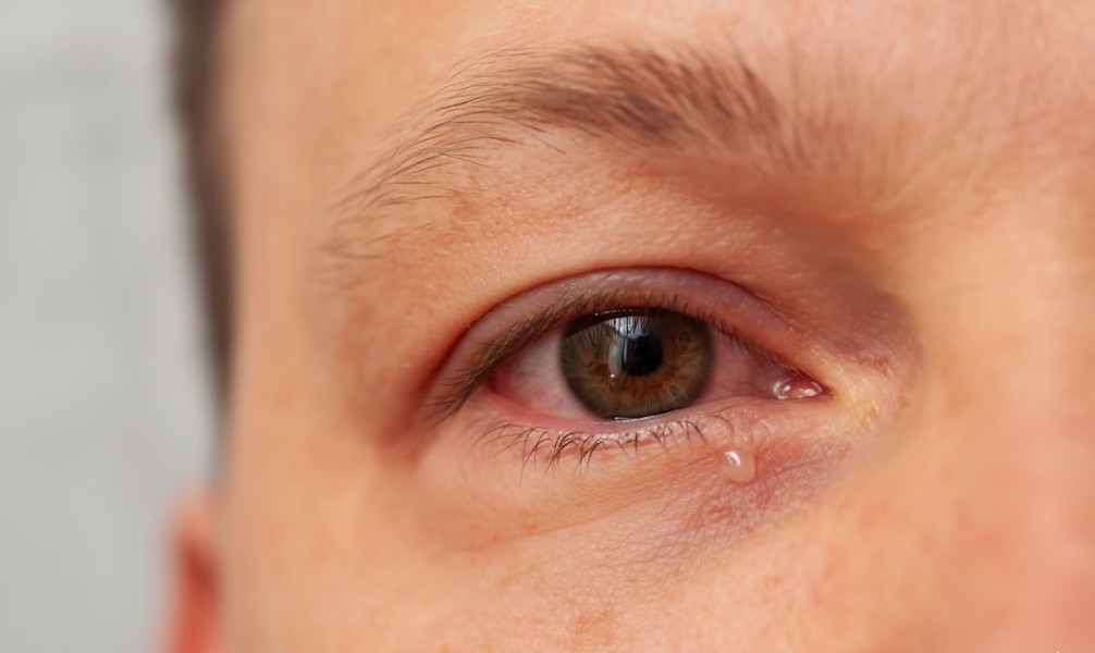 Close-up of eye redness and inflammation caused by Anterior Uveitis.