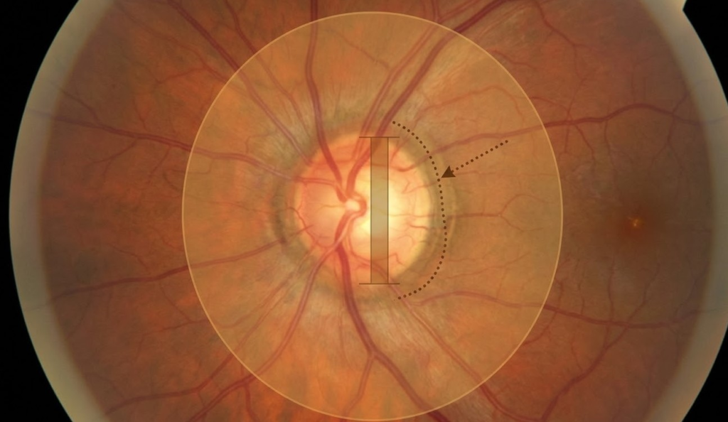 Clinical view of early glaucoma signs in the human eye showing optic nerve cupping and retinal nerve fiber layer thinning.